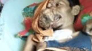 Penderita Tumor Ganas di Wajah Asal Labuhanbatu Diperbolehkan Pulang