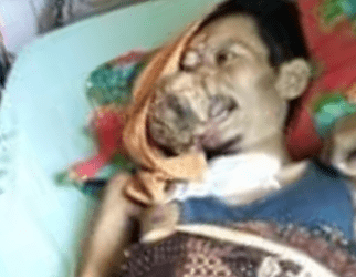 Penderita Tumor Ganas di Wajah Asal Labuhanbatu Diperbolehkan Pulang