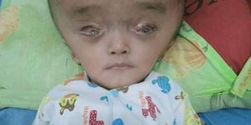 Balita Penderita Hidrocepalus ini Butuh Uluran Tangan Dermawan