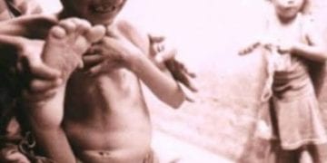 6 Warga Gambir Baru Derita Gizi Buruk, di Mutiara 3 Orang