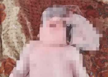 Bayi di Madina Lahir dengan Otak Diluar Tempurung Kepala, Dalam 2 Tahun Sudah 6 Anak Terlahir Cacat 