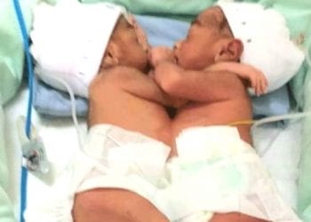 Bayi Kembar Siam Dempet Perut Asal Labura, Dirawat di RSUP H Adam Malik
