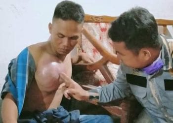 Kasiadi Penderita Kanker Payudara di Asahan Terima Bantuan dari GM Pekat IB