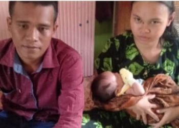 Tak Punya Anus, Bayi di Simalungun Ini Selalu Nangis Saat Mau BAB